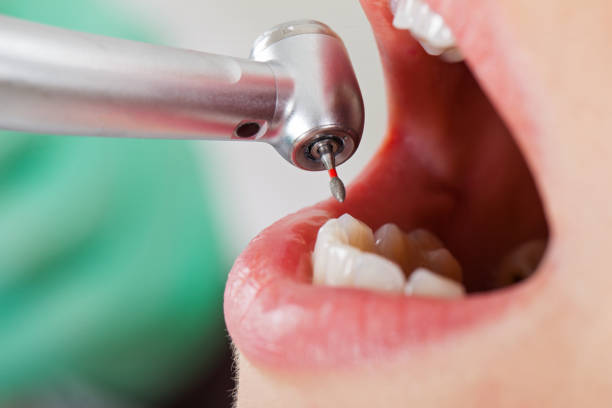 Best Urgent Care for Lost Fillings or Crowns in Timberville, VA